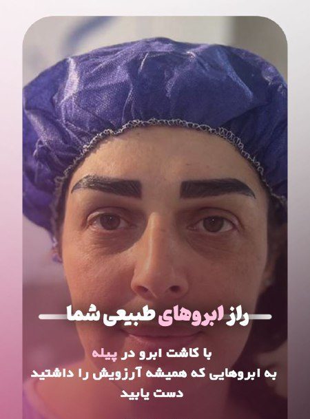 کاشت ابرو در پوست و موی سحر