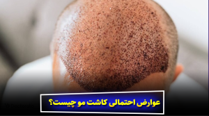 عوارض احتمالی کاشت مو چیست؟ و چطور جلوگیری کنیم؟ بهترین سن