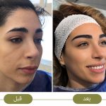 کاشت ابرو طبیعی زنانه کلینیک سحر