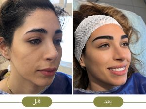 کاشت ابرو طبیعی زنانه کلینیک سحر
